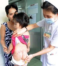 Bộ Y tế chỉ đạo tăng cường phòng chống dịch bệnh tay-chân-miệng