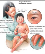 Bệnh kawasaki trên trẻ em: cần quan tâm và lưu ý trong thực hành lâm sàng