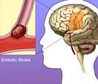 Thuốc Aspirin và mũ công nghệ cao trong phát hiện và ngăn ngừa bệnh đột quỵ