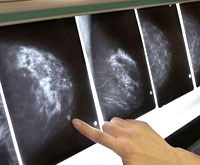 Nghiên cứu: Chụp nhũ ảnh đồ 3-D giúp cải thiện chẩn đoán