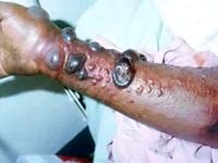 Bộ Y tế ban hành hướng dẫn chẩn đoán và điều trị bệnh do vi rút Ebola