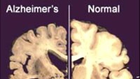 Vitamin D giúp ngăn chặn chứng sa sút trí tuệ, bệnh Alzheimer