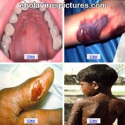 Bức tranh toàn cảnh về dịch bệnh Ebola tại một số quốc gia Tây Phi đến cuối tháng 8/2014