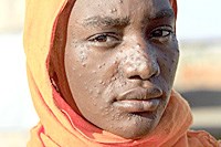Căn bệnh gây chết người Kala Azar đang gia tăng ở Nam Sudan