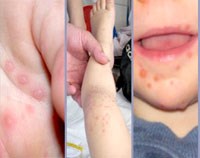 Phòng bệnh tay chân miệng ở trường mầm non, mẫu giáo