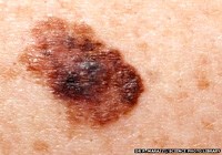 Các bệnh viện ghi nhận các ca ung thư da đang tăng nhanh