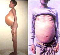 Hai căn bệnh ký sinh trùng có thể gây ung thư ở người