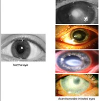 Một bệnh lý nhãn khoa nguy hiểm do ký sinh trùng Hartmanella sp. hay Acanthamoeba sp.