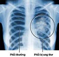 Các nhà khoa học phát hiện ra Ung thư phổi có thể nằm ẩn dấu trong vòng 20 năm 