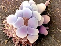 Xét nghiệm mới giúp xác định điều trị ung thư buồng trứng tốt nhất