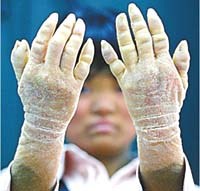 Một số bệnh lý da hiếm gặp trên lâm sàng 