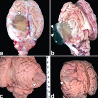 Bệnh lý hiếm gặp trên lâm sàng do hai tác nhân ký sinh trùng gây viêm màng não tăng bạch cầu ái toan ở người 