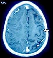 Một số ấn phẩm khoa học về ký sinh trùng gây tổn thương hệ thần kinh trung ương
