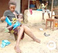 Các bệnh ký sinh trùng nhiệt đới bị lãng quên và sự đói nghèo ở Mỹ