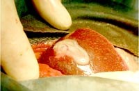 Áp xe gan do đơn bào amip-bệnh cũ nhưng biến chứng đe dọa tính mạng bệnh nhân 