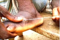 Bệnh giun chỉ Dracunculiasis có chiều hướng quay trở lại sẽ là gánh nặng bệnh tật toàn cầu ?