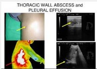 Tổng hợp y văn và cập nhật: Nhân một trường hợp tràn dịch màng phổi tăng bạch cầu ái toan hai bên do tác nhân ký sinh trùng 