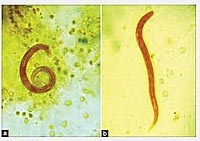Các ấn phẩm nghiên cứu cập nhật về bệnh giun lươn Strongyloides stercoralis ở người