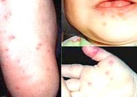 Điểm tin y tế từ các báo ngày 19/1 và 20/1 năm 2014