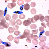 Điều trị sốt rét phải đánh giá đáp ứng hiệu lực thuốc sử dụng