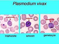 Sốt rét tái phát mặc dầu đã sử dụng đúng liệu trình Primaquine