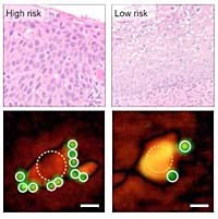 Thiết bị gắn trên điện thoại thông minh có thể phát hiện ra các tế bào ung thư