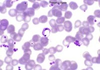 Điểm tin y tế từ các báo ngày 22/4 đến 23/4 năm 2015 