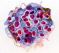 Bằng cách nào mà sốt rét lừa được hệ thống miễn dịch của chúng ta