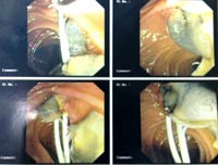 Đặc điểm tổn thương hệ gan-mật do sán lá gan lớn Fasciola gigantica ở người qua chẩn đoán siêu âm, chúp cắt lớp vi tính (CT-SCAN), chụp cộng hưởng từ (MRI) và nội soi mật tụy ngược dòng (ERCP) 