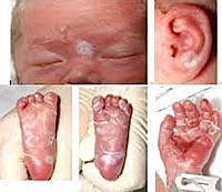 Bệnh giang mai bẩm sinh