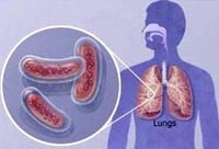 WHO: Thông tin cập nhật về bệnh lao