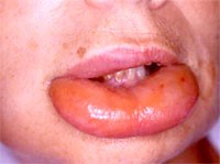 Cần chủ động ngăn ngừa dị ứng thuốc 