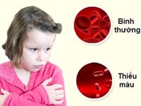 Thiếu máu: cách điều trị và phòng bệnh 