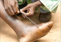 WHO: cập nhật bệnh giun guinea (Dracunculiasis)