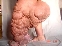 Maldives và Sri Lanka loại trừ giun chỉ bạch huyết (LF): bệ phóng chấm dứt LF toàn cầu