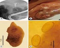 Chẩn đoán và điều trị bệnh sán lá gan lớn ở người do Fasciola hepatica và Fasciola gigantica (Phần 1)