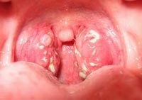 Chủ động phòng chống bệnh bạch hầu