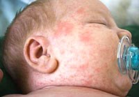 Sốt xuất huyết và sốt xuất huyết nặng