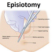 Tại sao phải cắt tầng sinh môn khi sinh con 