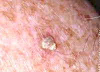 Các bệnh lý da thường gặp dễ nhầm với bệnh lý ký sinh trùng ở người cao tuổi 