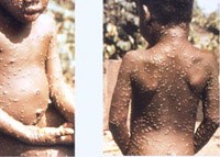 Dịch bệnh Monkeypox ở Cộng hòa Trung Phi