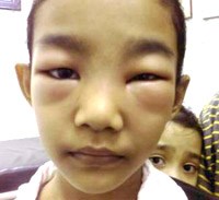 Ngăn ngừa bệnh viêm cầu thận cấp