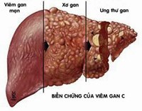 Điều cần biết về bệnh viêm gan C