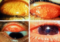 Morocco loại trừ bệnh mắt hột, nguyên nhân hàng đầu gây mù lòa