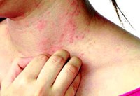 Phòng ngừa dị ứng thuốc điều trị