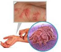 Cập nhật một số ấn phẩm nghiên cứu liên quan đến miễn dịch và điều trị bệnh ghẻ do Sarcopter scabies