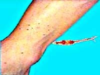 Cần nhiều nghiên cứu xác định Việt Nam có sán máng gây bệnh ở người hay không?