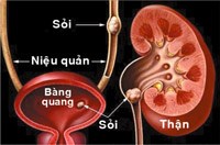 Phòng bệnh sỏi tiết niệu