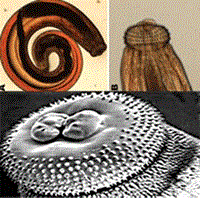 Nhân trường hợp nhiễm ấu trùng giun đầu gai Gnathostoma spinigerum di chuyển dưới da