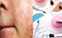 Dị ứng mỹ phẩm trên da cần chẩn đoán phân biệt với bệnh ký sinh trùng 
